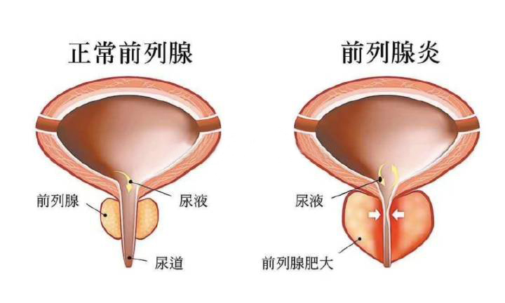 前列腺炎最新研究突破，開啟未來治療新篇章